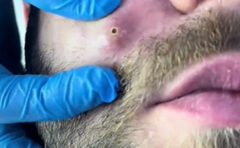 Blackhead Extractions EP:31