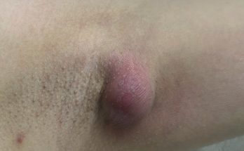 Abscess in the Armpit – Squeezed Once and the Pus Won’t Stop Flowing Out!