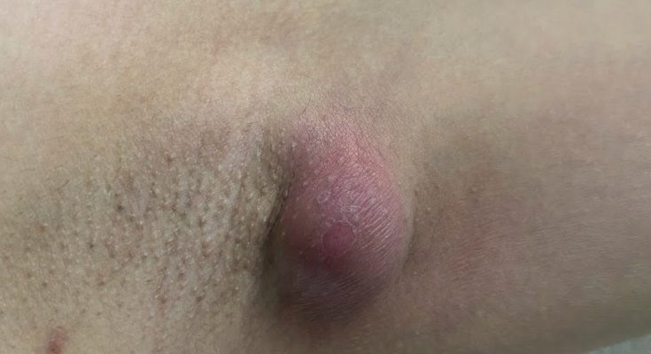 Abscess in the Armpit – Squeezed Once and the Pus Won’t Stop Flowing Out!