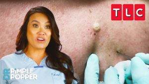 The BEST Blackhead Pops | Dr. Pimple Popper | TLC The BEST Blackhead Pops | Dr. Pimple Popper | TLC