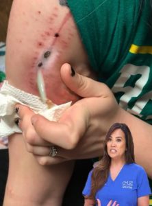 Simple and safe guide for blackhead removal and prevention Dr. Pimple Proper 001