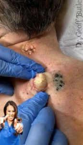 Simple and safe guide for blackhead removal and prevention Dr. Pimple Proper 007 Simple and safe guide for blackhead removal and prevention Dr. Pimple Proper 007